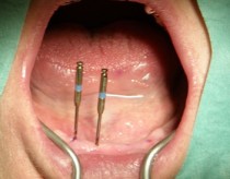 Mini implantátumokkal elhorgonyzott teljes alsó kivehető fogpótlás