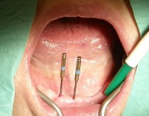 Fogászati Klinika - Mini implantátumokkal elhorgonyzott teljes alsó kivehető fogpótlás