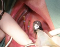 Mini implantátumokkal elhorgonyzott teljes alsó kivehető fogpótlás